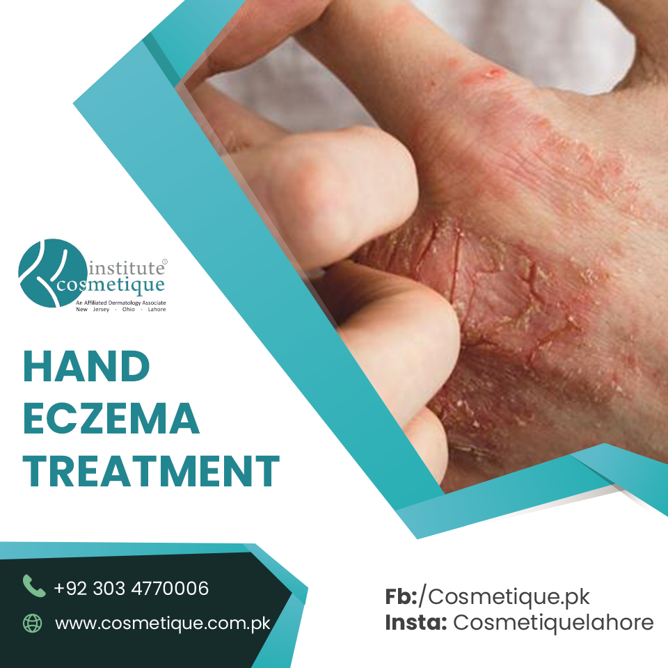 Best Hand Eczema Treatment