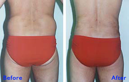 Liposuction Flanks