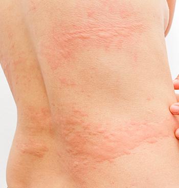 Common Causes of Urticaria and treatment
