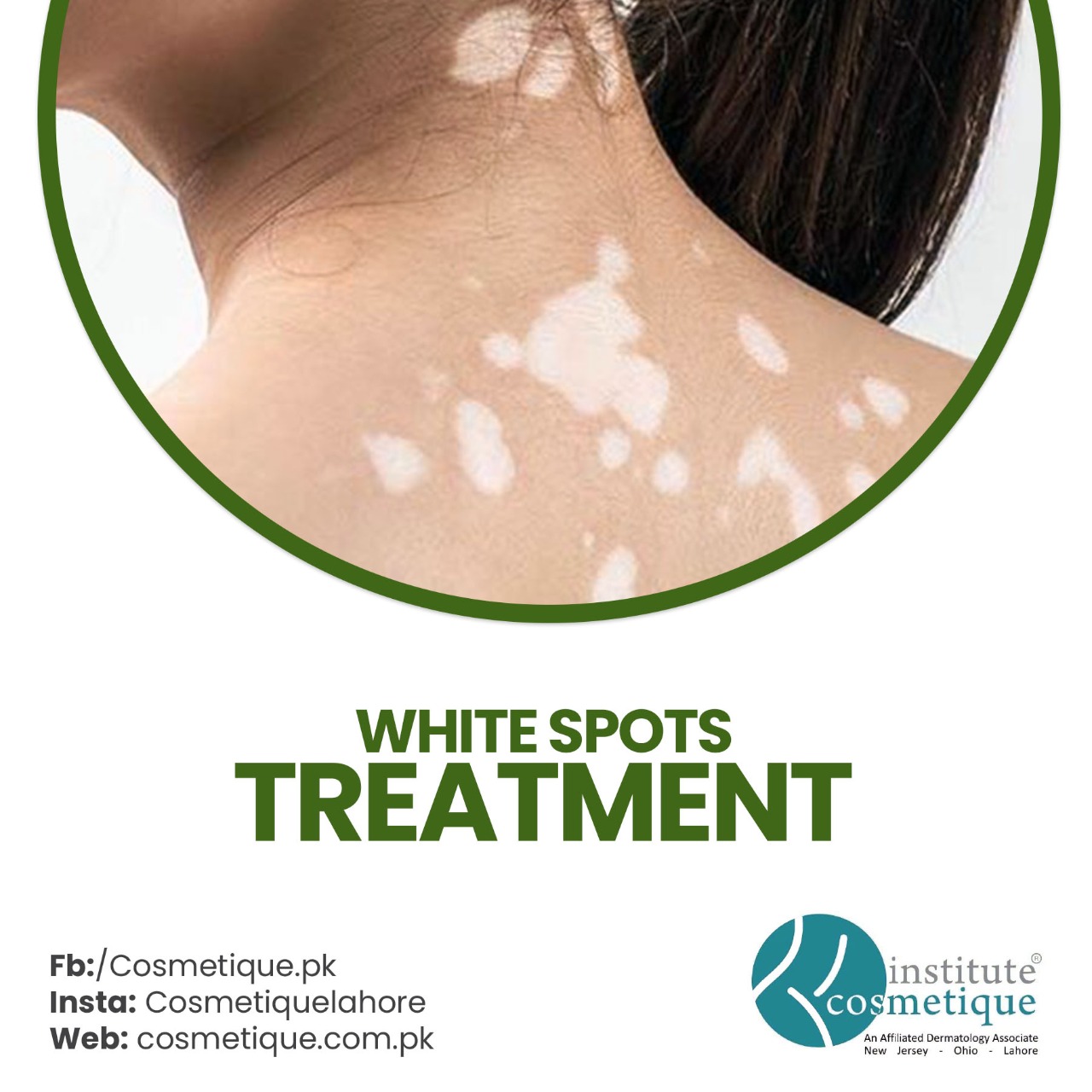  White Spots Treatment in Lahore