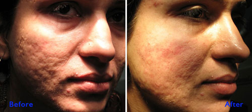 Acne treatment in lahore at cosmetique
