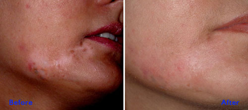 Vitiligo-Vitiligo Treatment Before and After