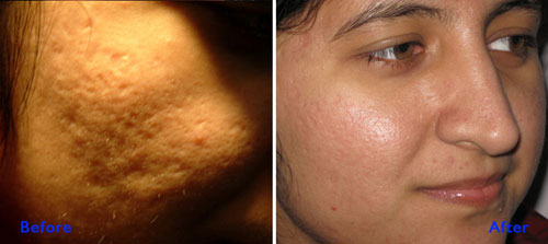 Acne Scar Treatment